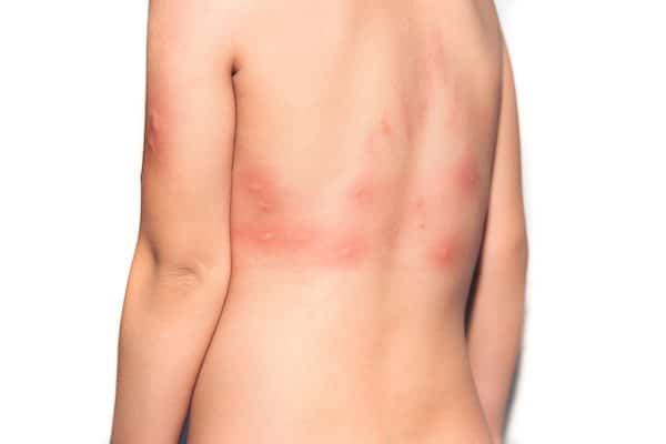 Κνίδωση και αγγειοοίδημα