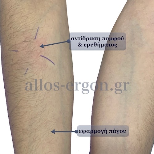 Ερύθημα και πομφός σε  διαφορετικό σημείο από την εφαρμογή του πάγου