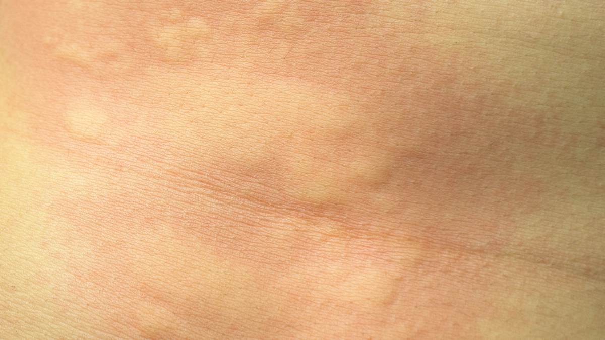 Κνιδωτικό εξάνθημα