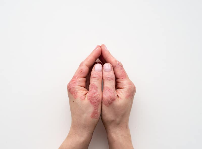 Ψωρίαση σε χέρια