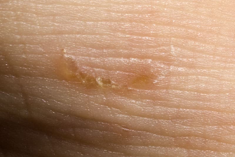 Penarc, Scabies-RechterFuss, CC BY 3.0  