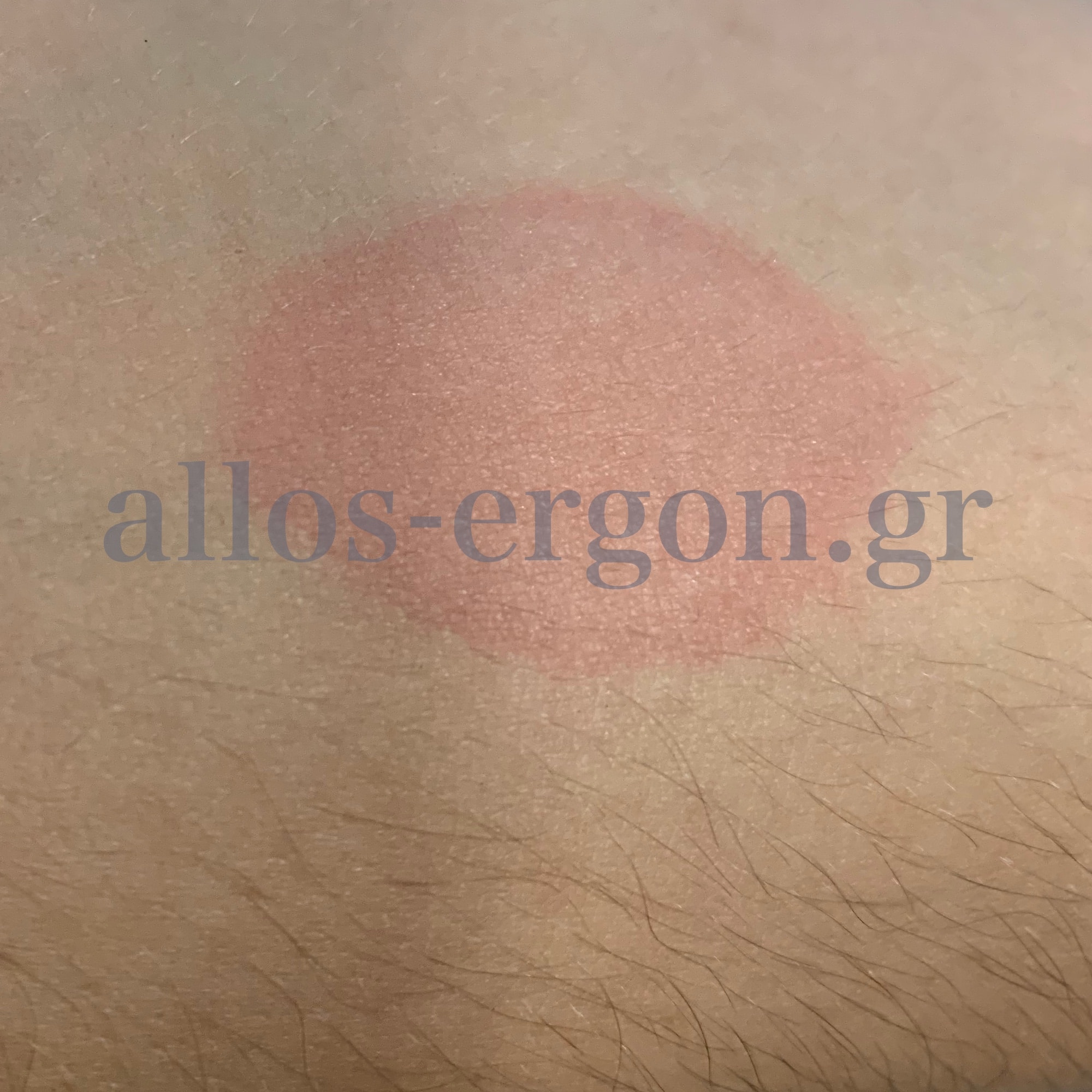 Ερύθημα και πομφός στο αντιβράχιο μετά από θετική δοκιμασία πάγου — κνίδωση εκ ψύχους