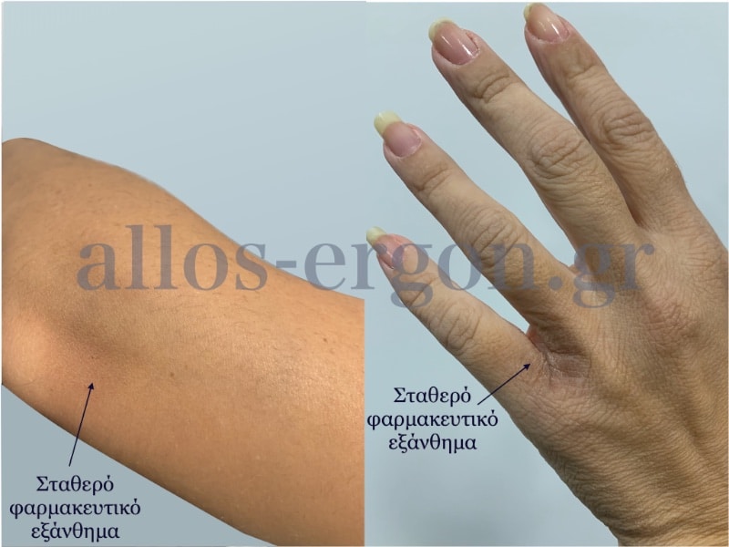 Σταθερό φαρμακευτικό εξάνθημα σε φάση αποδρομής (1 εβδομάδα) μετά τη λήψη μελοξικάμης