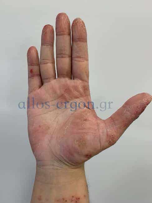 Αλλεργική εξ επαφής δερματίτιδα σε latex και παραφαινυλενοδιαμίνη