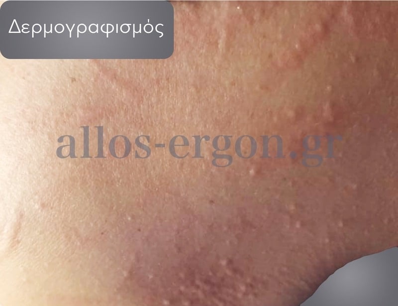 Δερμογραφισμός βλάβες