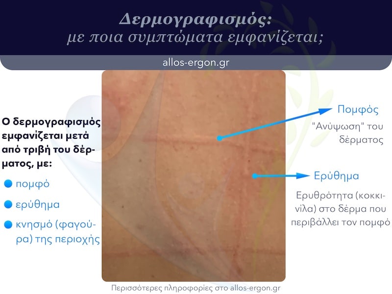Δερμογραφισμός συμπτώματα