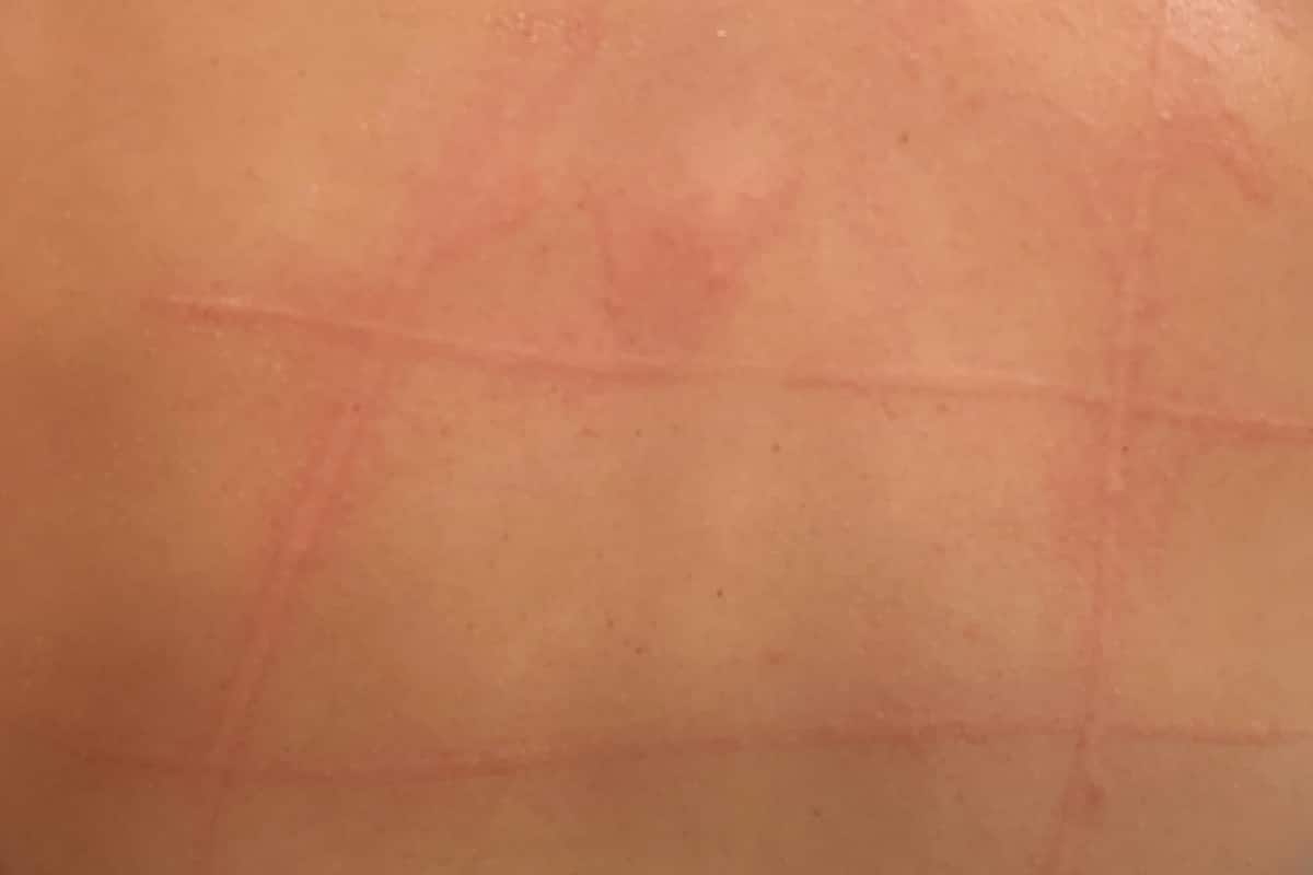 Δερμογραφισμός