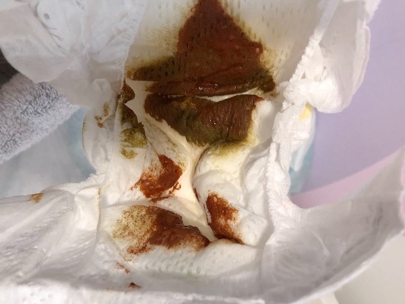 Αίμα και βλέννη στα κόπρανα βρέφους με αλλεργική πρωκτοκολίτιδα — FPIAP