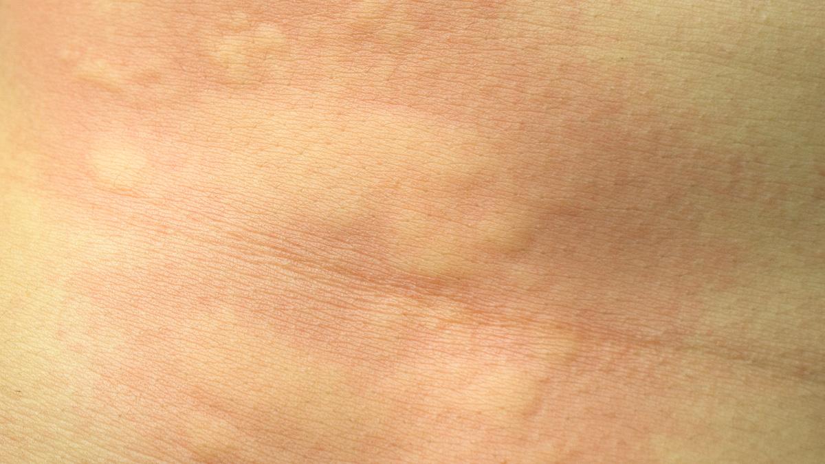 Χρόνια (αυτοάνοση) κνίδωση