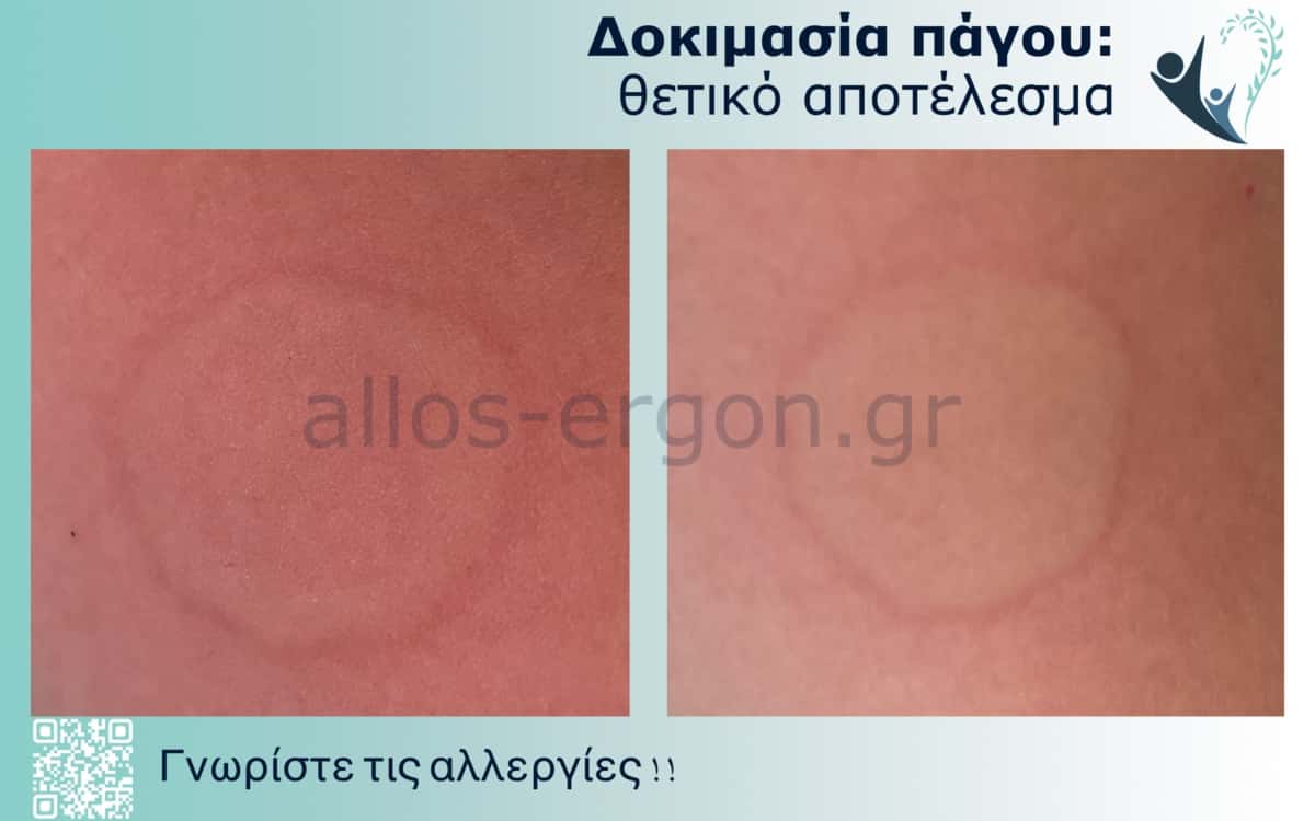 Εξέλιξη μιας θετικής δοκιμασίας πάγου (τεστ πάγου) μέσα σε λίγα λεπτά