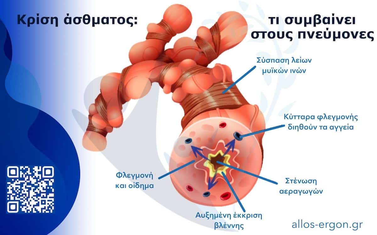 Τι συμβαίνει στους αεραγωγούς των πνευμόνων σε ένα παροξυσμό