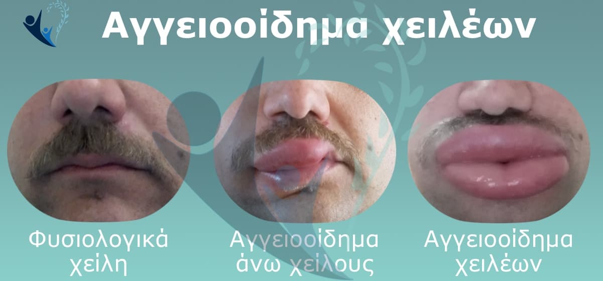Αγγειοοίδημα (πρήξιμο) σε χείλη