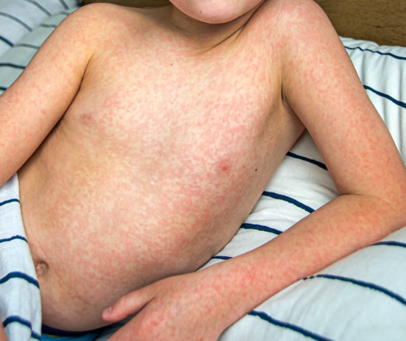 Ιογενές εξάνθημα