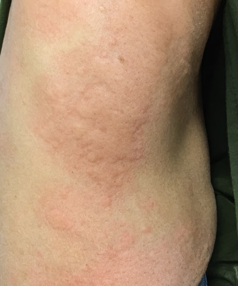 Κνιδωτικό εξάνθημα στο σώμα