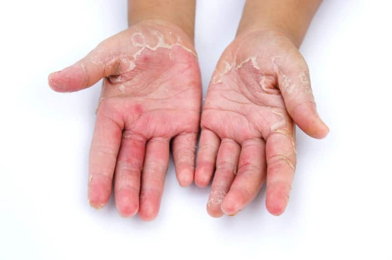 Εξ επαφής δερματίτιδα στα χέρια