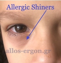 αλλεργικές πτυχές