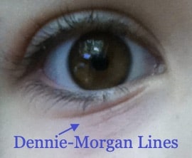 γραμμές Dennie-Morgan