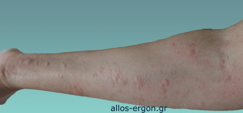 αλλεργία σε αντιβίωση εξάνθημα
